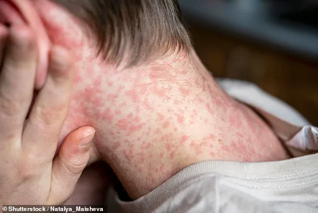 Measles Outbreak Triggers Lockdown at Dilley ICE Facility; Two Cases Prompt Public Health Measures