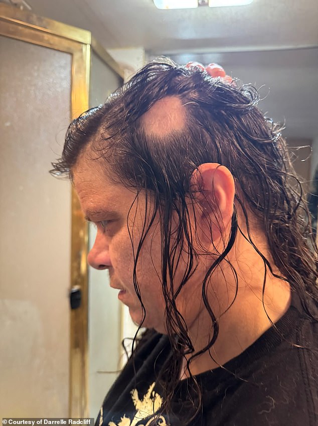 Woman Fears Baldness After Spot Appears, Finds Cure in Cheap Rosemary Shampoo